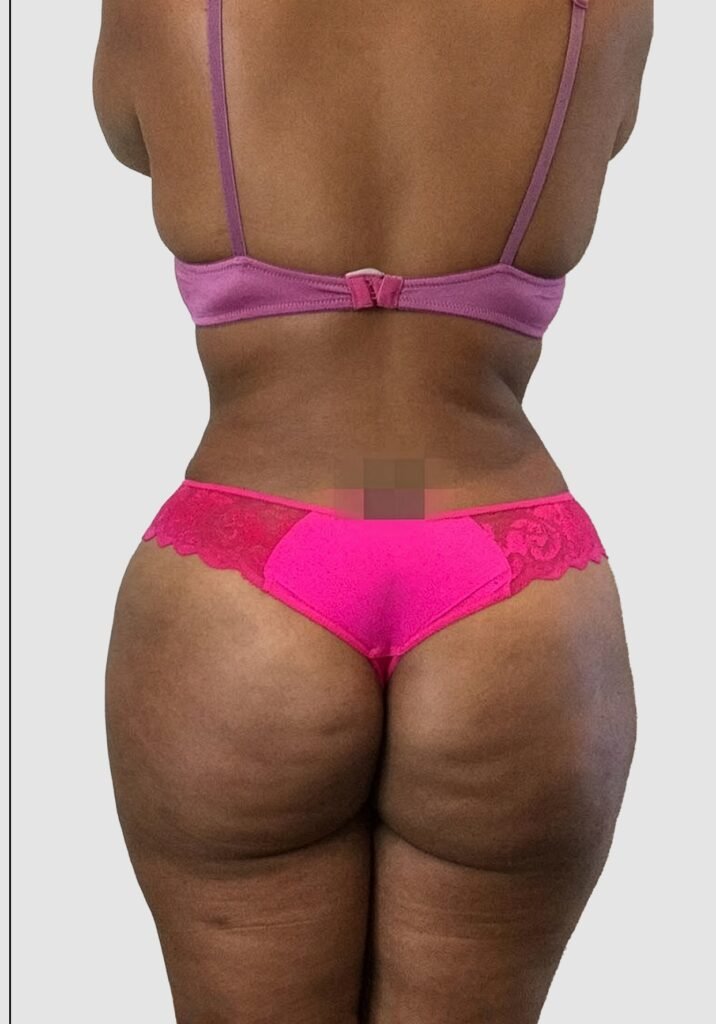 Before and after results of BBL procedure performed by Dr. Magna. after