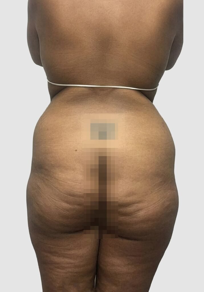 Before and after results of BBL procedure performed by Dr. Magna. before