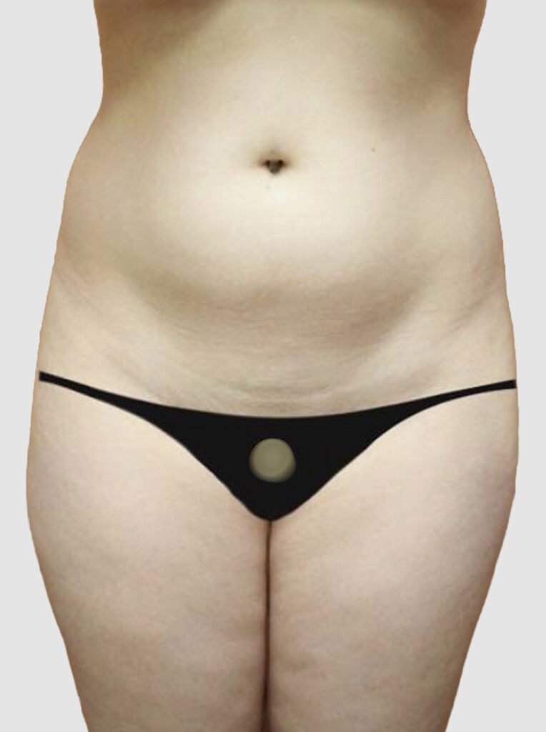 Before and after results of BBL procedure (with donor-site liposuction) performed by Dr. Magna. after