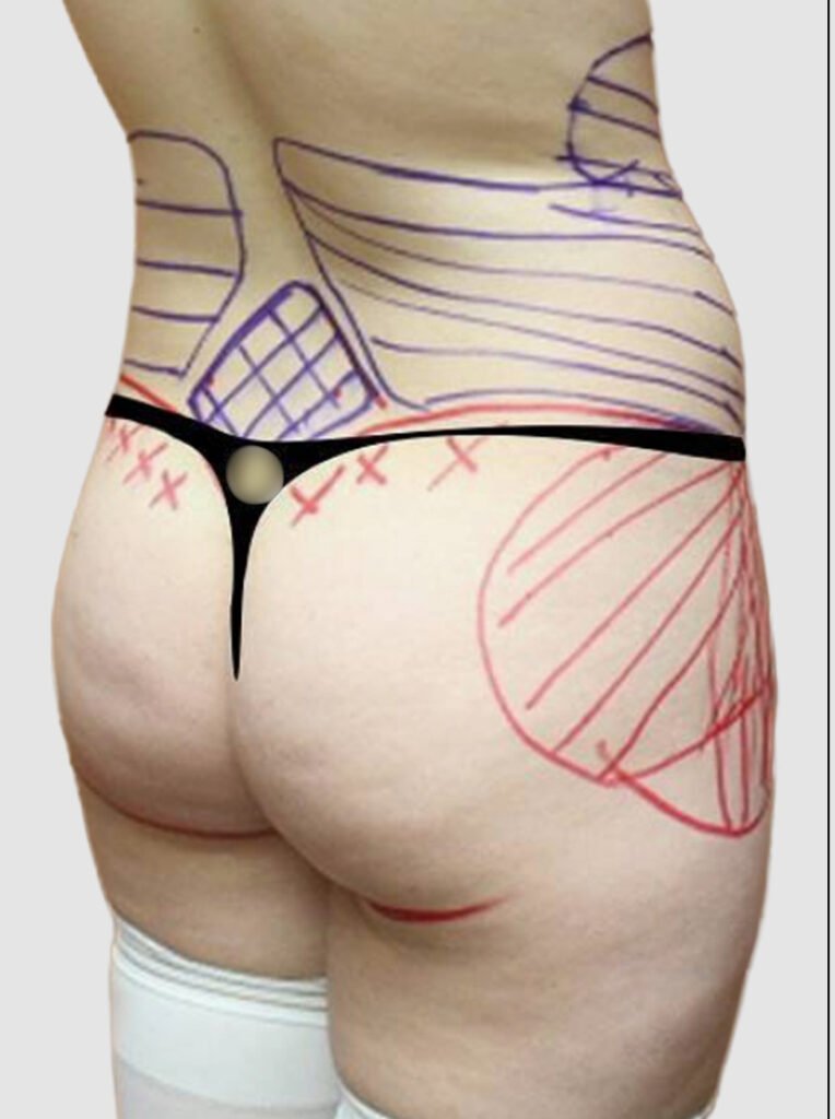 Before and after results of BBL procedure (with donor-site liposuction) performed by Dr. Magna. before