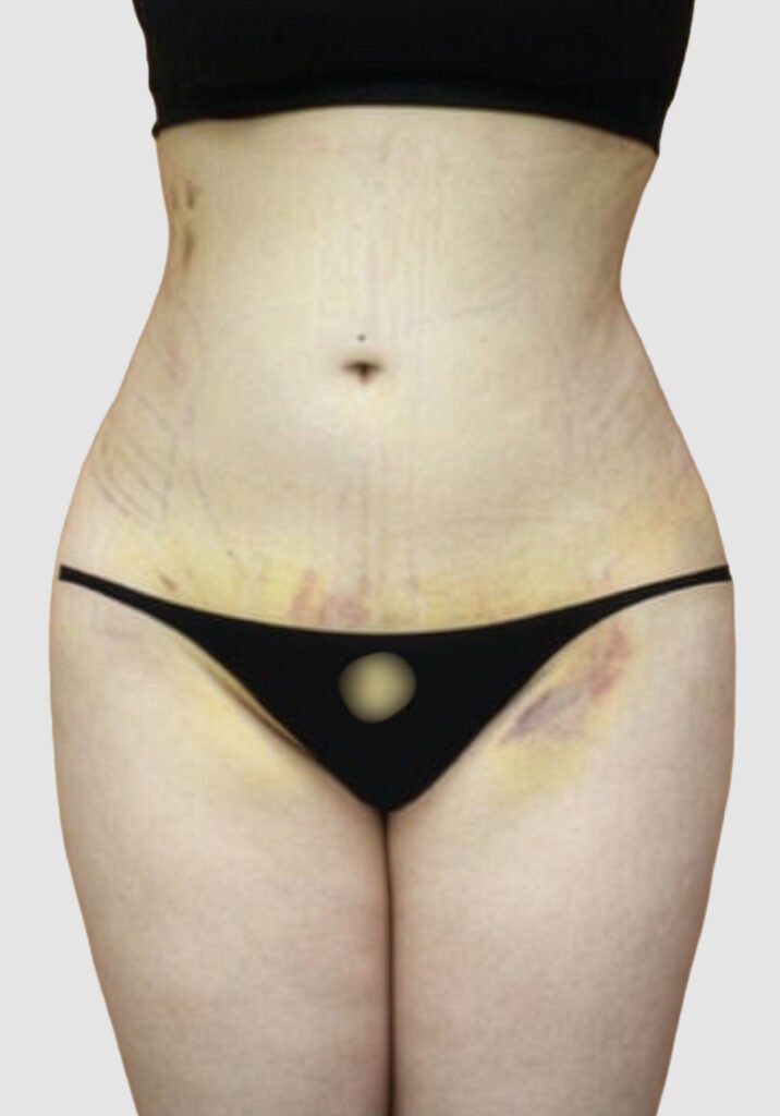 Before and after results of BBL procedure performed by Dr. Magna. after