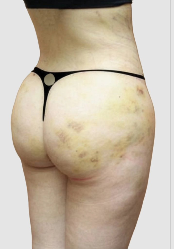Before and after results of BBL procedure performed by Dr. Magna. before
