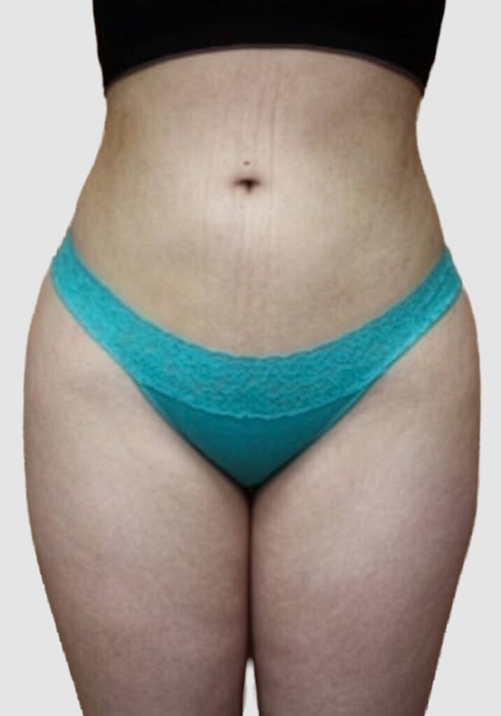 Before and after results of BBL procedure performed by Dr. Magna. after