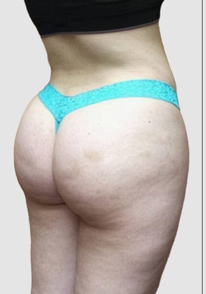 Before and after results of BBL procedure performed by Dr. Magna. before