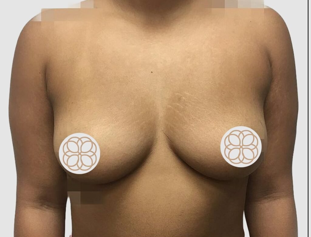 Before and after results of breast augmentation performed by Dr. Magna. before