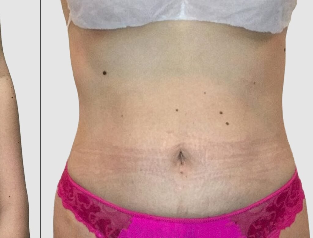 Before and after results of abdominal liposuction performed by Dr. Magna. after
