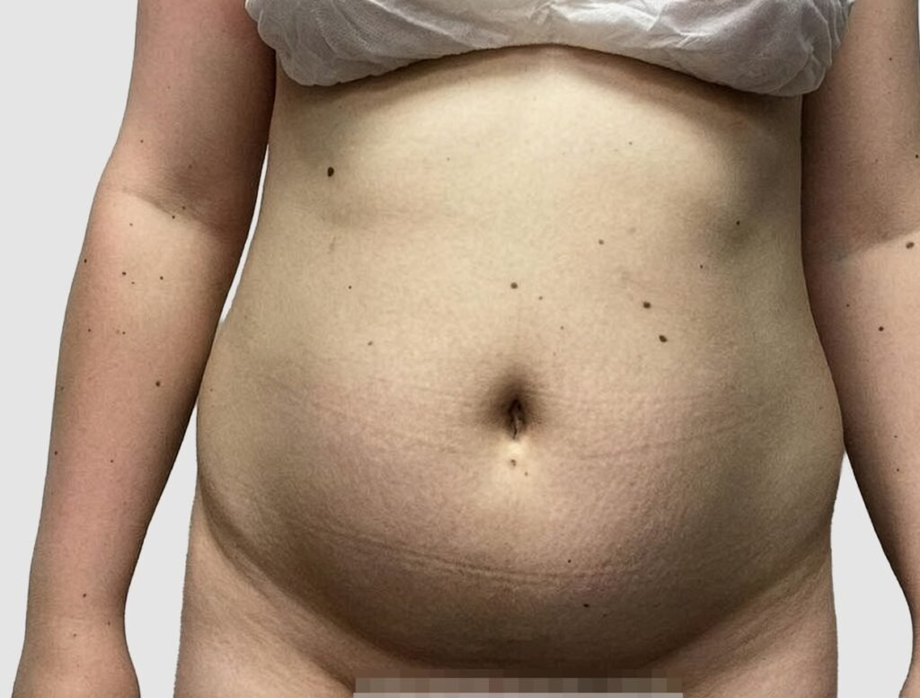 Before and after results of abdominal liposuction performed by Dr. Magna. before