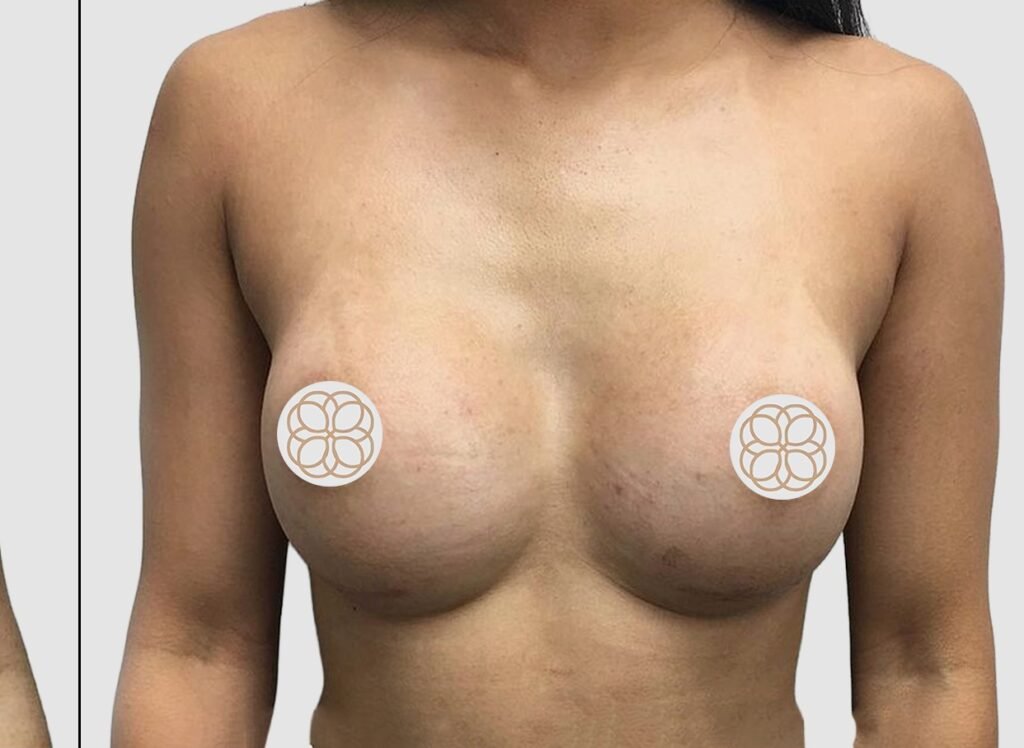 Before and after results of breast augmentation performed by Dr. Magna. after
