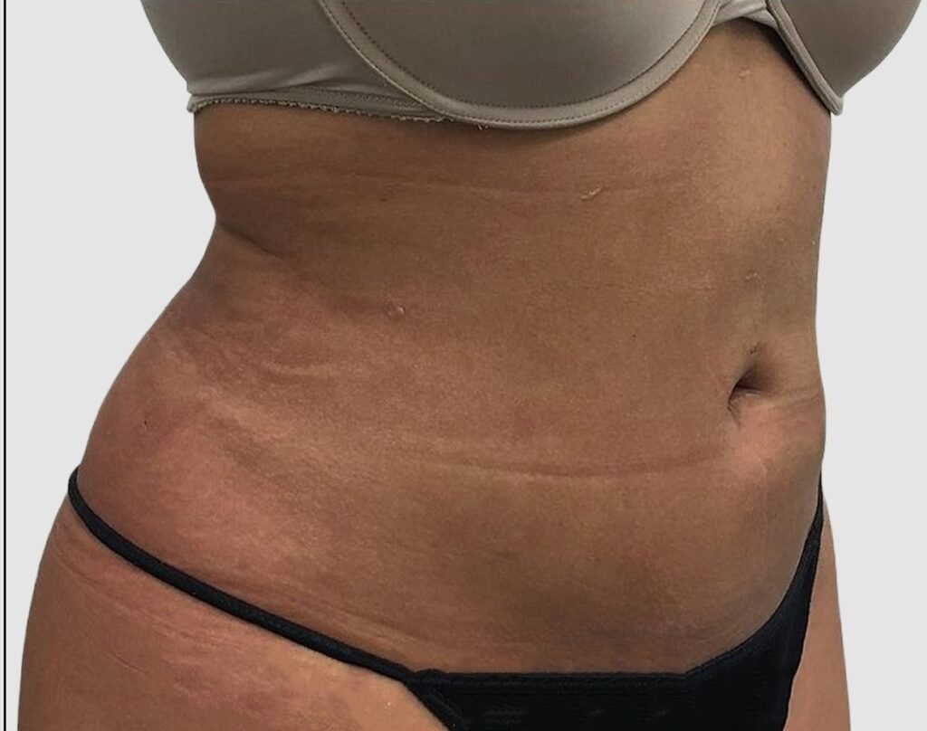 Before and after results of abdominal liposuction performed by Dr. Magna. after