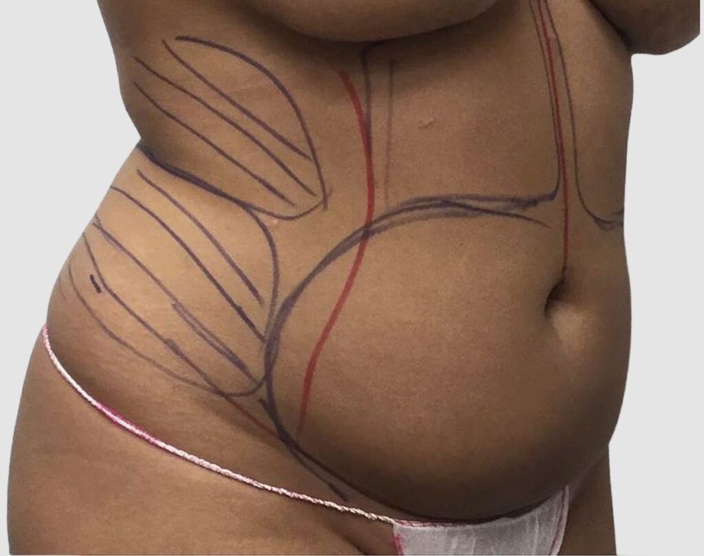 Before and after results of abdominal liposuction performed by Dr. Magna. before
