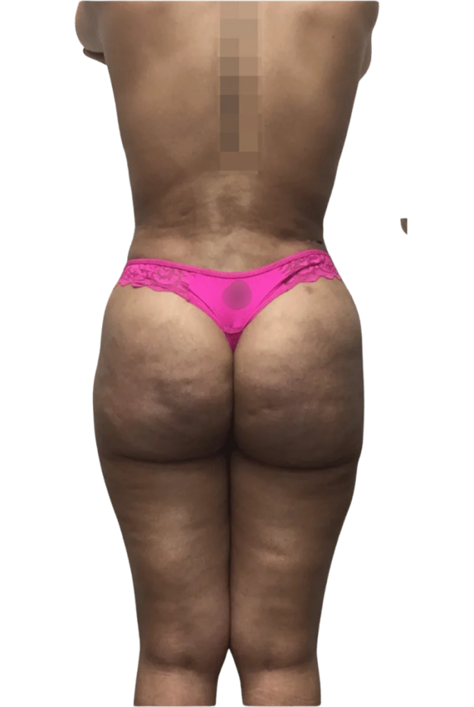 BBL + Liposuction surgery after