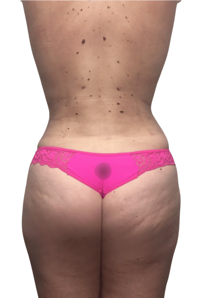 Liposuction after